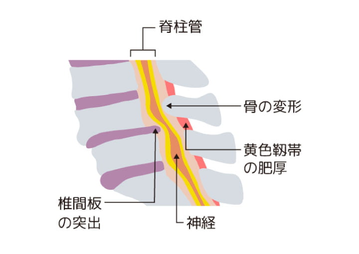 脊柱管狭窄症イラスト