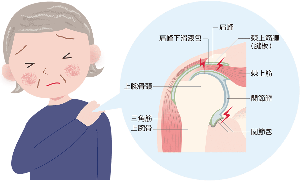 肩関節を構成する筋肉の図