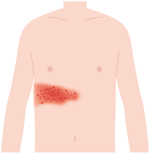 帯状疱疹の症状が出ている体（正面）