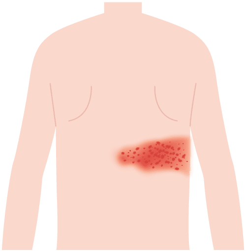 帯状疱疹の症状が出ている体（背中）