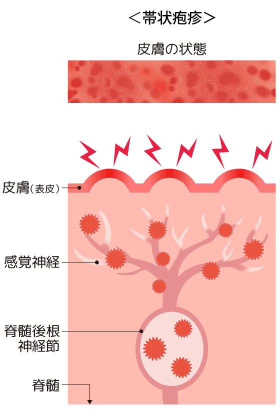 帯状疱疹の図表