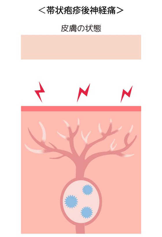 状疱疹後神経痛の図表
