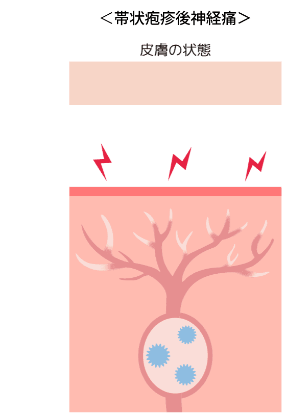 状疱疹後神経痛の図表